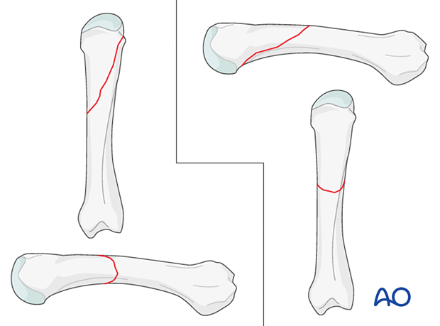 AP and lateral views of oblique metacarpal fractures