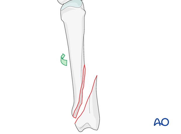 Rotation of finger for direct visualization of an oblique metacarpal fracture