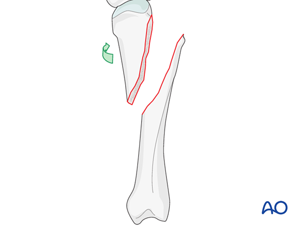 Rotation of finger for direct visualization of an oblique metacarpal fracture