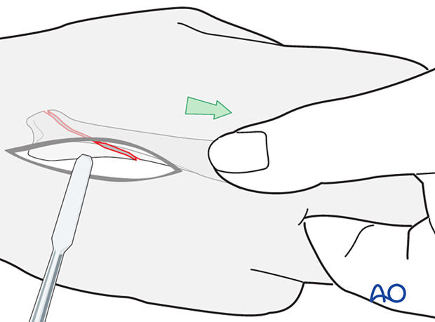 Traction of finger for reduction of an oblique metacarpal fracture