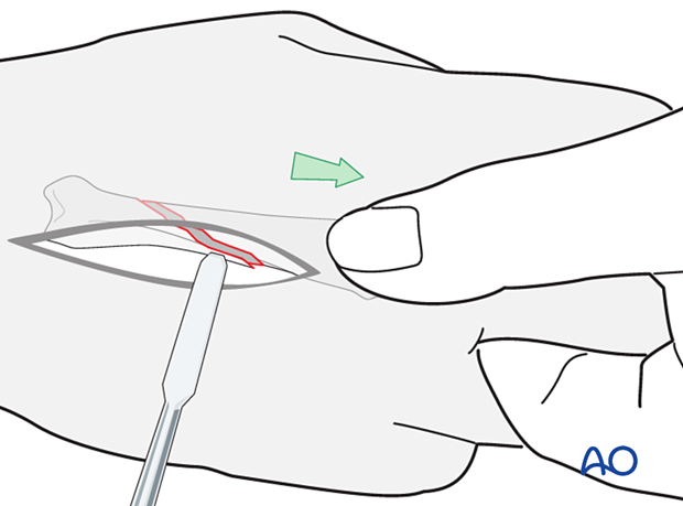 Traction of finger for reduction of an oblique metacarpal fracture