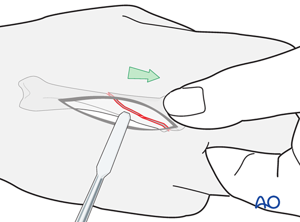 Traction of finger for reduction of an oblique metacarpal fracture