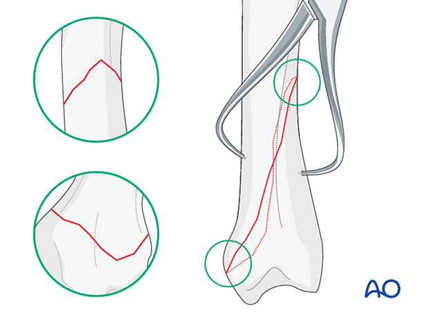 Application of pointed reduction forceps to reduce and hold an oblique metacarpal fracture