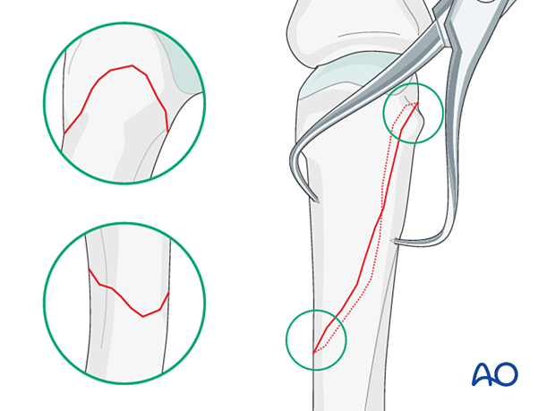 Application of pointed reduction forceps to reduce and hold an oblique metacarpal fracture