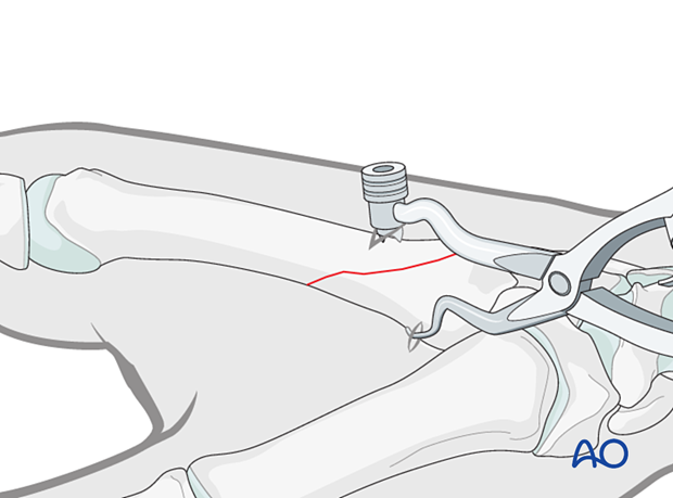 Reduction of an oblique metacarpal fracture with reduction forceps.