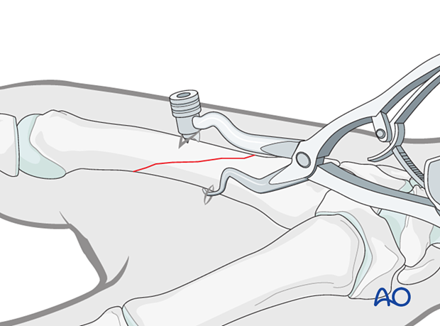 Reduction of an oblique metacarpal fracture with reduction forceps.