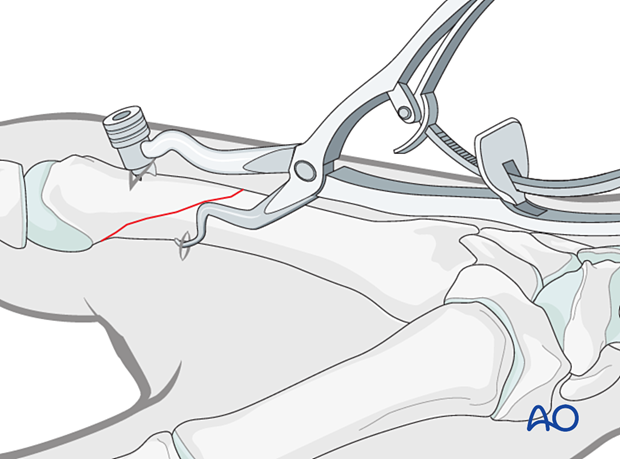 Reduction of an oblique metacarpal fracture with reduction forceps.