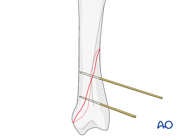 Two K-wires inserted to provisionally hold reduction of an oblique metacarpal fracture