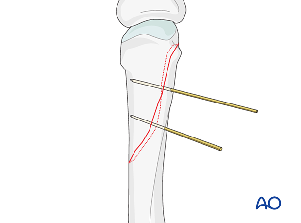 Two K-wires inserted to provisionally hold reduction of an oblique metacarpal fracture