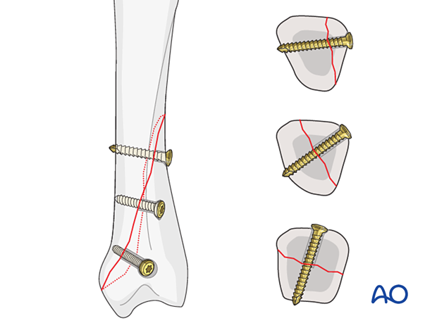 Lag screws inserted perpendicularly to the fracture plane for fixation of an oblique metacarpal fracture