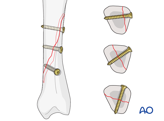 Lag screws inserted perpendicularly to the fracture plane for fixation of an oblique metacarpal fracture