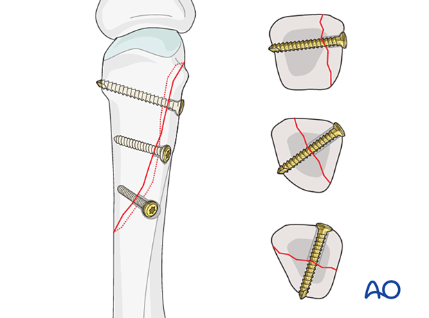 Lag screws inserted perpendicularly to the fracture plane for fixation of an oblique metacarpal fracture