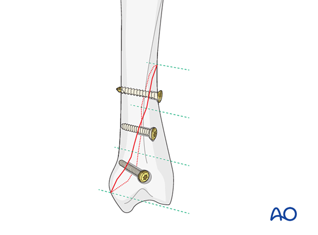 Fixation of an oblique metacarpal fracture with three lag screws