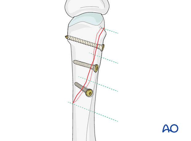 Fixation of an oblique metacarpal fracture with three lag screws