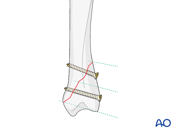 Fixation of an oblique metacarpal fracture with two lag screws