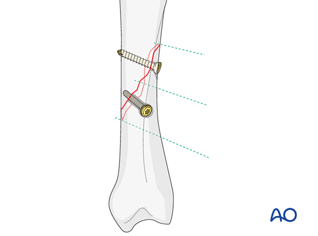 Fixation of an oblique metacarpal fracture with two lag screws