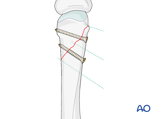 Fixation of an oblique metacarpal fracture with two lag screws