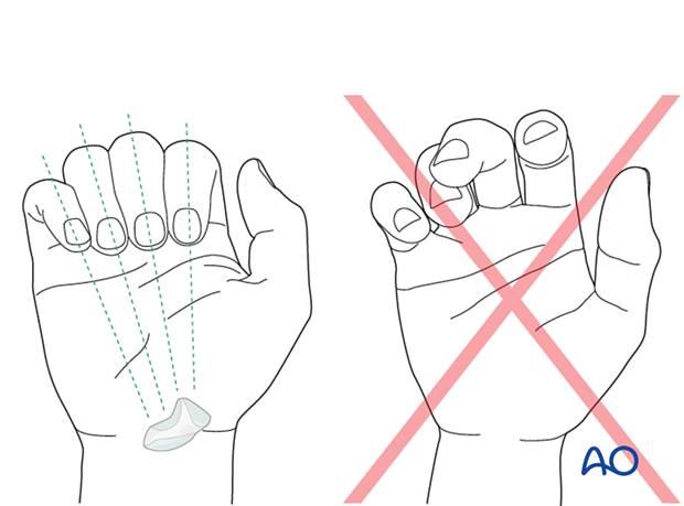 Fingertips of flexed fingers should point to the scaphoid. Malrotation manifests by overlap of a flexed finger over its neighbors.