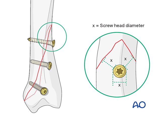 Screw placement not close to the fracture apex and with minimal distance to the fracture line equal to the diameter of the screw head