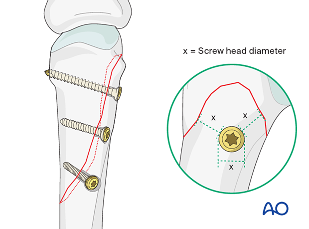 Screw placement not close to the fracture apex and with minimal distance to the fracture line equal to the diameter of the screw head