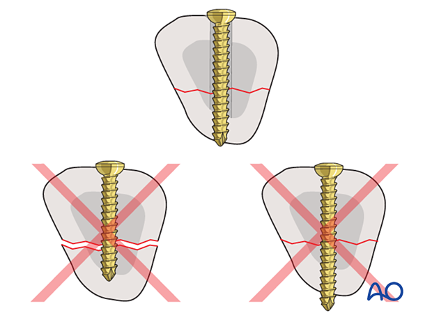 Correct screw length for fracture fixation means screws should not be too long or too short.