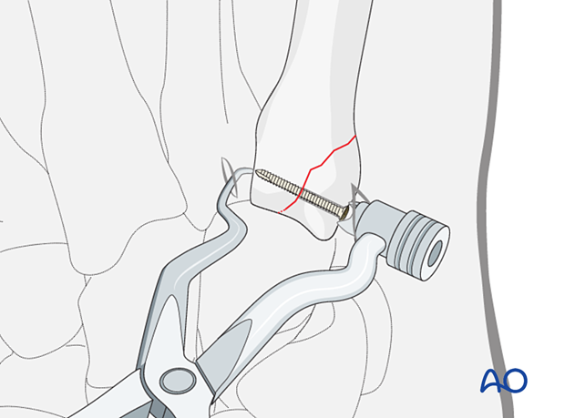 Percutaneous lag-screw fixation of a partial articular fracture of the metacarpal base