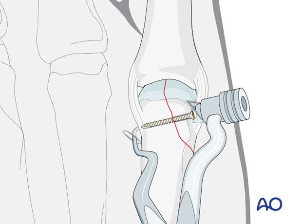 Percutaneous lag-screw fixation of a partial articular fracture of the metacarpal head