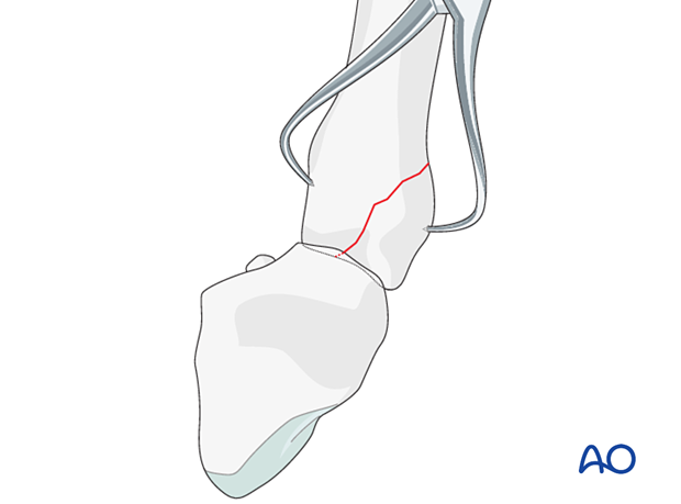 Holding the reduction of a partial articular fracture of the metacarpal base with reduction forceps