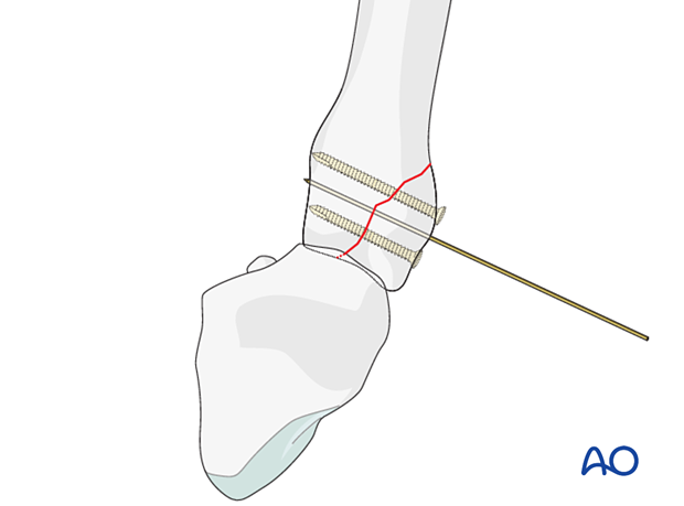 Holding the reduction of a partial articular fracture of the metacarpal base with a K-wire avoiding the planned screw tracks