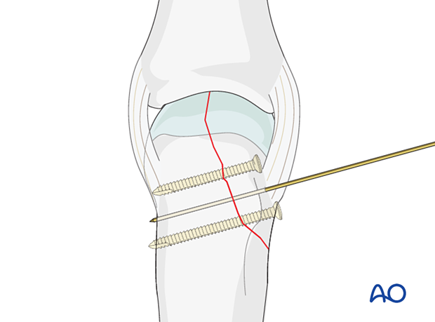 Holding the reduction of a partial articular fracture of the metacarpal base with a K-wire avoiding the planned screw tracks