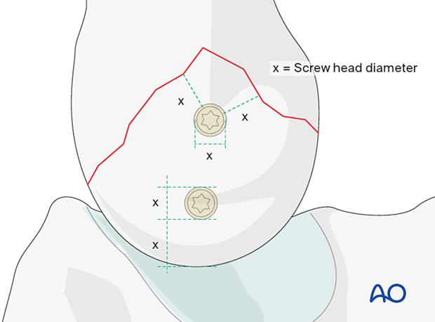 Screw placement not close to the fracture apex and with minimal distance to the fracture line equal to the diameter of the screw head