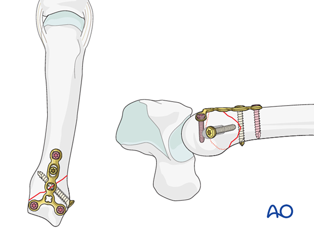 Lag screw fixation with neutralization plate of an oblique metacarpal fracture 