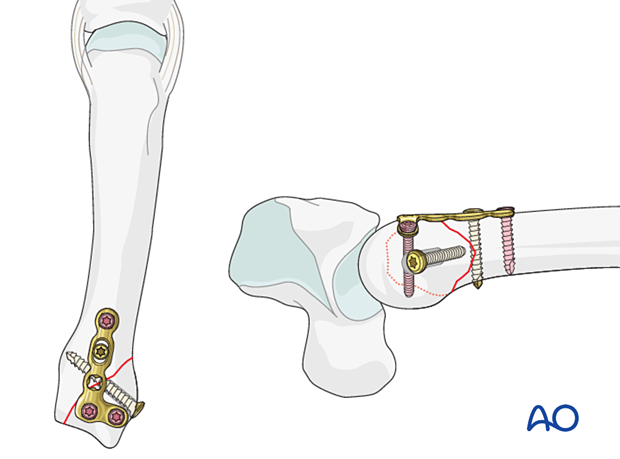 Lag screw fixation with neutralization plate of an oblique metacarpal fracture 