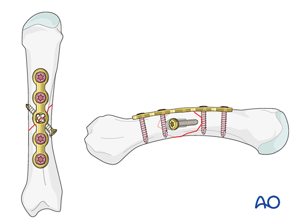 Lag screw fixation with neutralization plate of an oblique metacarpal fracture 