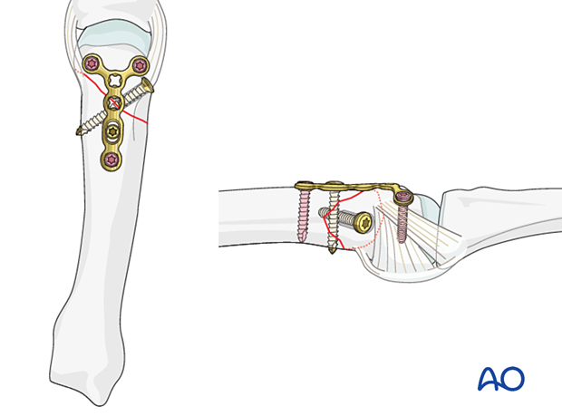 Lag screw fixation with neutralization plate of an oblique metacarpal fracture 