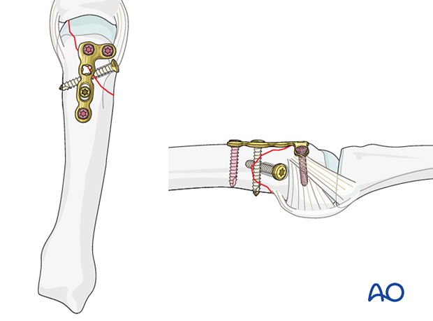 Lag screw fixation with neutralization plate of an oblique metacarpal fracture 