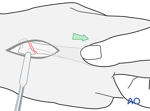 Reduction of an oblique metacarpal fracture