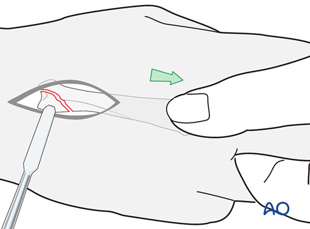 Reduction of an oblique metacarpal fracture