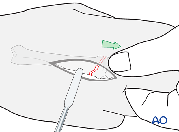 Reduction of an oblique metacarpal fracture