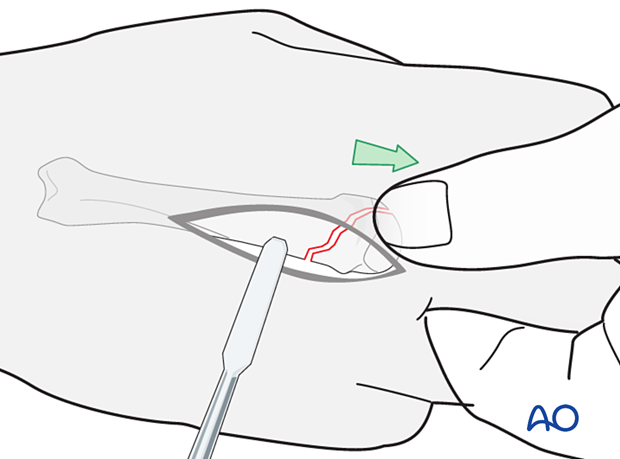 Reduction of an oblique metacarpal fracture