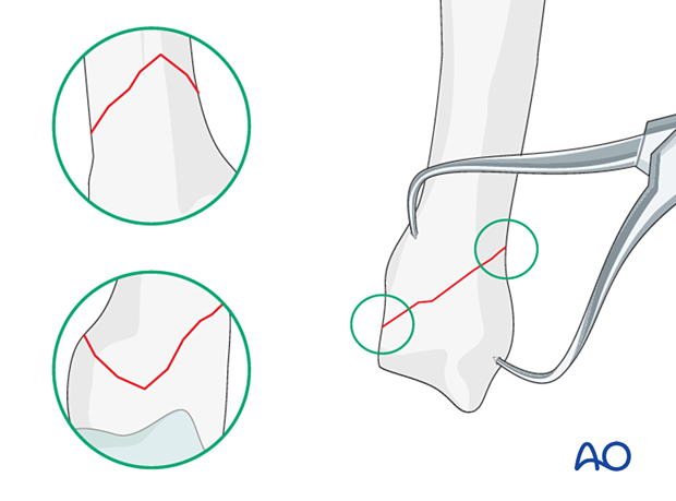 Reduction of an oblique metacarpal fracture with reduction 