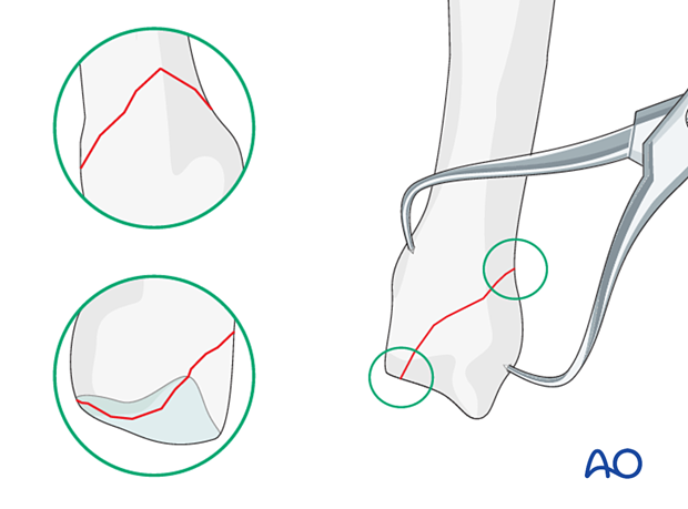 Reduction of an oblique metacarpal fracture with reduction 