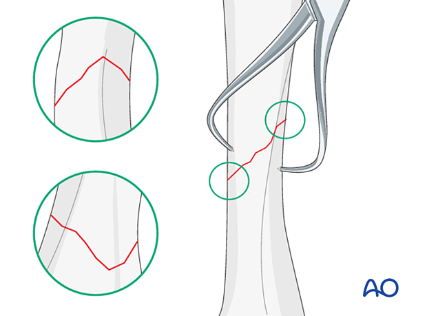 Reduction of an oblique metacarpal fracture with reduction 