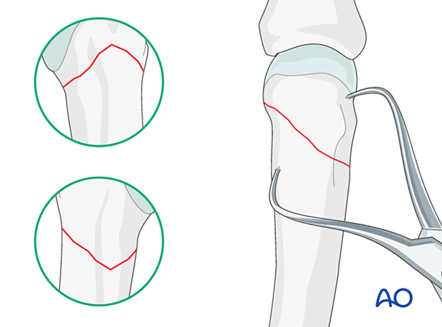 Reduction of an oblique metacarpal fracture with reduction 