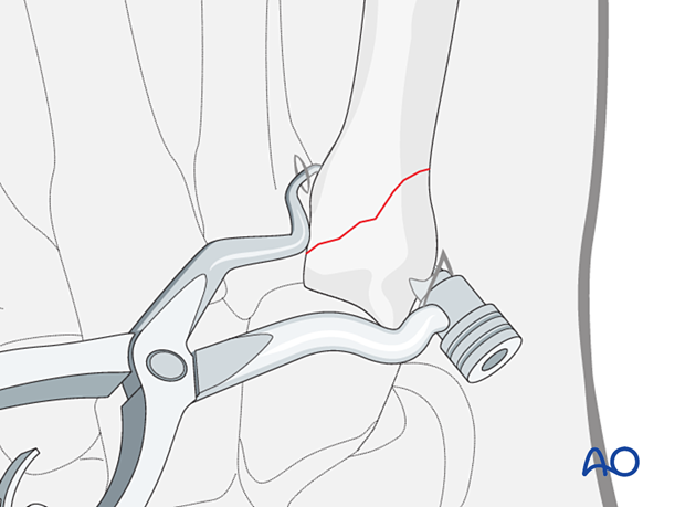 Reduction of an oblique metacarpal fracture with reduction forceps designed for percutaneous screw insertion