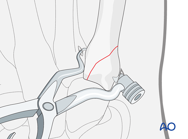 Reduction of an oblique metacarpal fracture with reduction forceps designed for percutaneous screw insertion