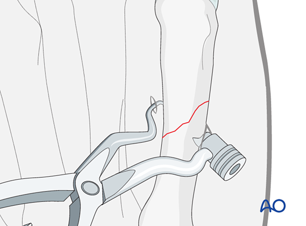 Reduction of an oblique metacarpal fracture with reduction forceps designed for percutaneous screw insertion