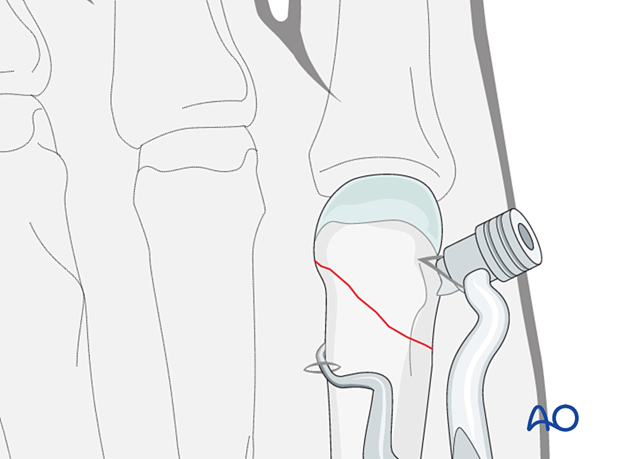 Reduction of an oblique metacarpal fracture with reduction forceps designed for percutaneous screw insertion