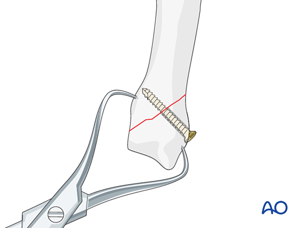 Lag screw fixation with neutralization plate of an oblique metacarpal fracture – lag screw insertion