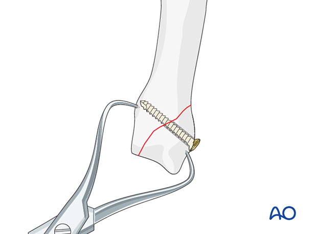 Lag screw fixation with neutralization plate of an oblique metacarpal fracture – lag screw insertion